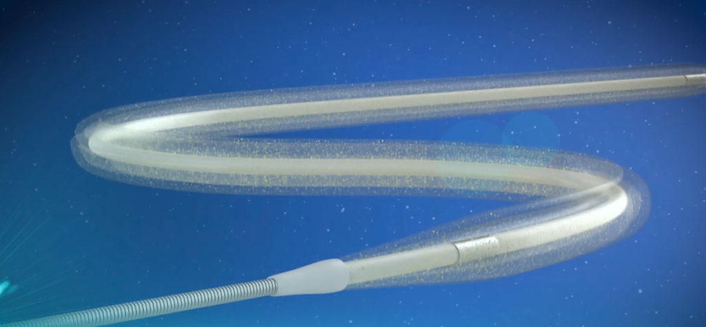 Image: The MagicTouch Sirolimus coated balloon catheter (Photo courtesy of Concept Medical)