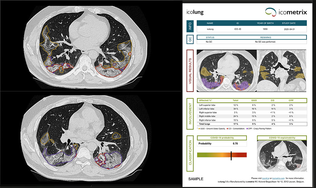 Image: AI Software Detects COVID-19 Patients at Early Stage as Well as Quantifies Extent of Lung Lesions (Photo courtesy of icometrix)