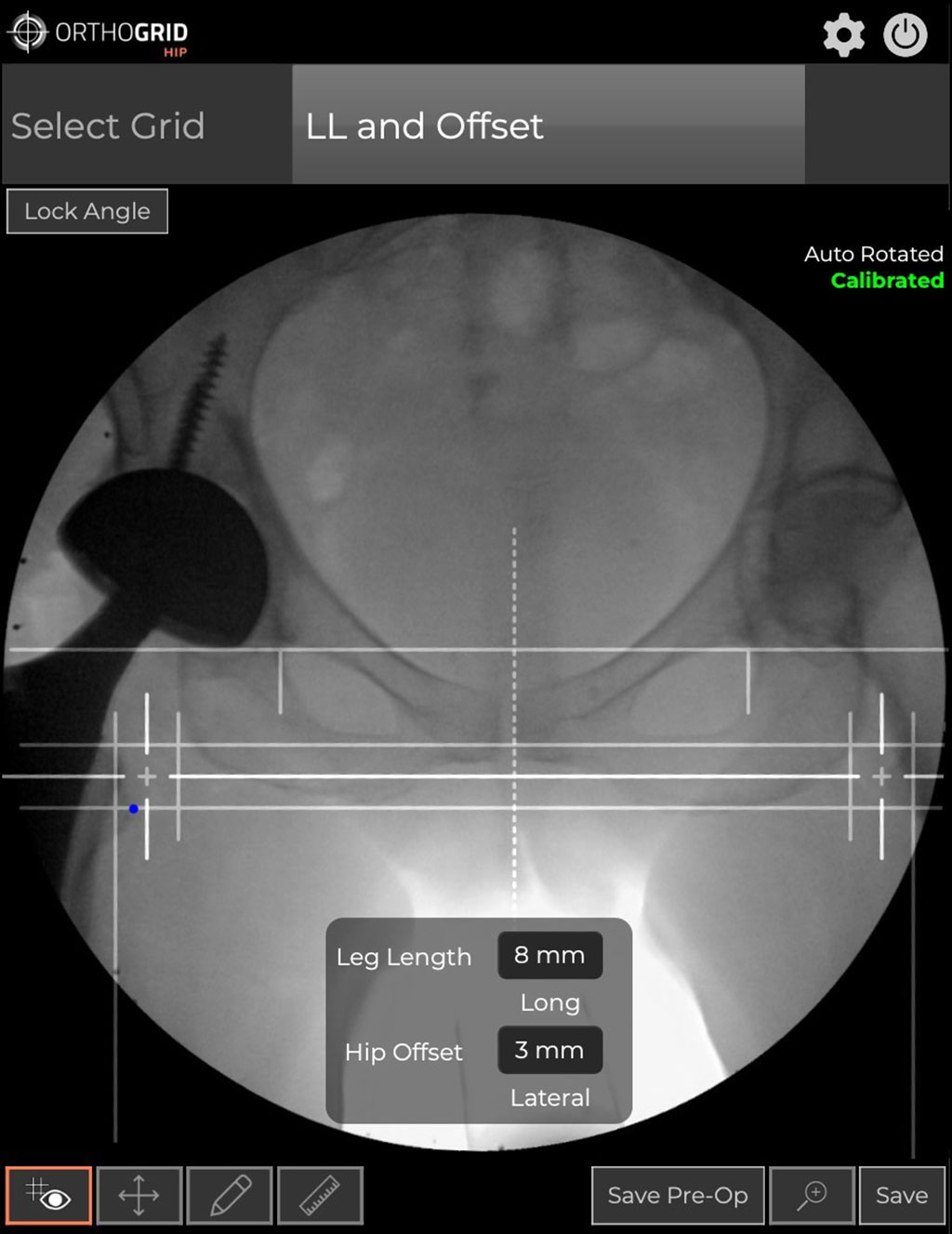 Image: The OrthoGrid Hip tool for direct anterior approach THA (Photo courtesy of OrthoGrid)