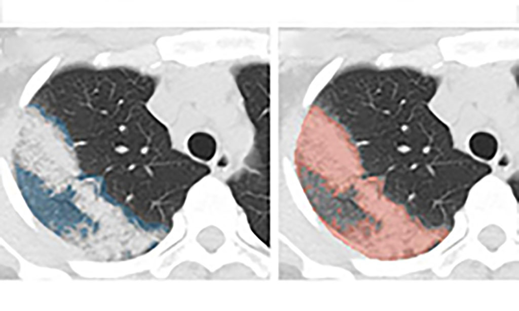 Image: AI-Accelerated Method Monitors COVID-19 Disease Severity over Time from Patient Chest CT Scans (Photo courtesy of NVIDIA)