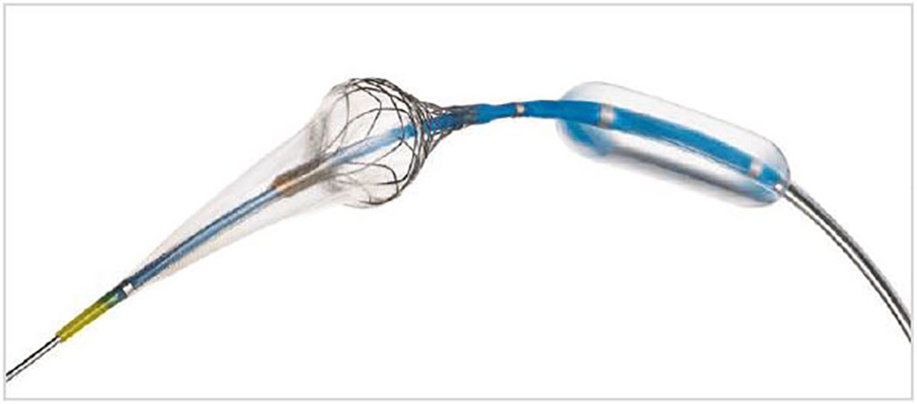 Image: The Neuroguard integrated embolic protection (IEP) system (Photo courtesy of Contego Medical)