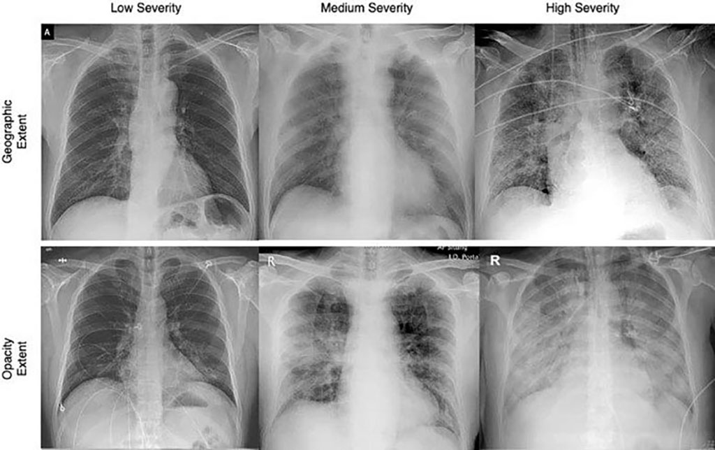 Image: Chest x-rays used in the COVID-Net study show differing infection extent and opacity in the lungs of COVID-19 patients (Photo courtesy of University of Waterloo)