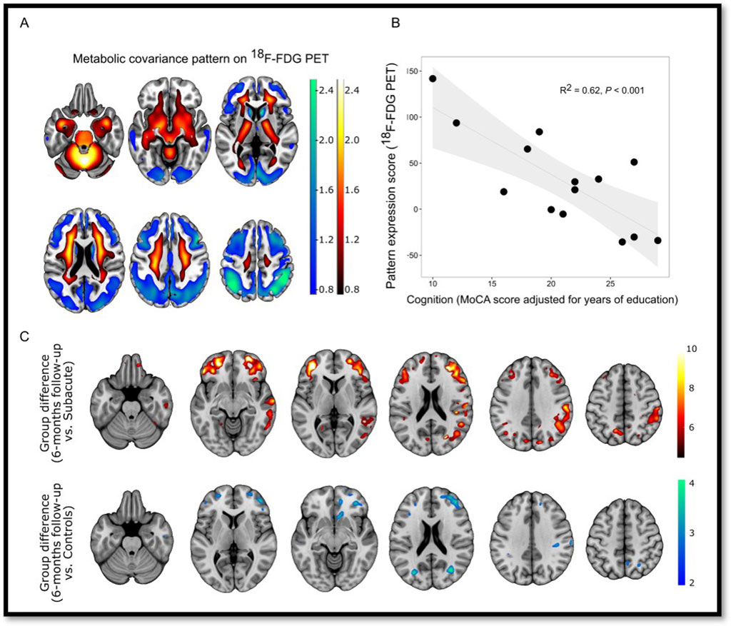 Image: PET Imaging Can Accurately Measure Cognitive Impairment in COVID-19 Patients(Photo courtesy of G Blazhenets et al., Department of Nuclear Medicine, Medical Center – University of Freiburg, Faculty of Medicine, University of Freiburg)