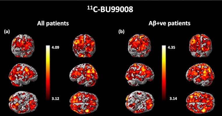 Mapping analysis of significantly increased 11C-BU99008 uptake (Image courtesy of Molecular Psychiatry)