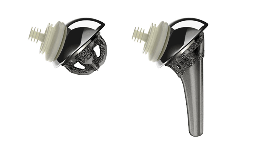 Image: Stemless and stemmed versions of the Inhance Shoulder System (Photo courtesy of DePuy Synthes)
