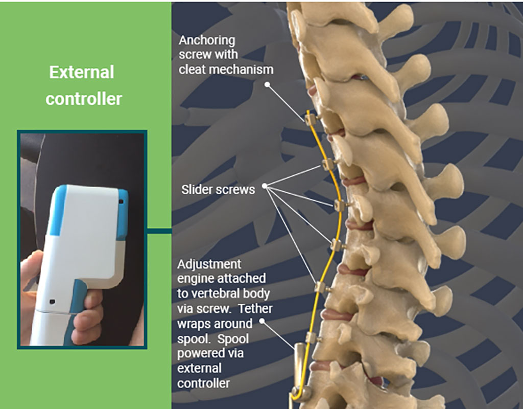 Image: A dynamic VBT system treats pediatric scoliosis (Photo courtesy of Auctus Surgical)