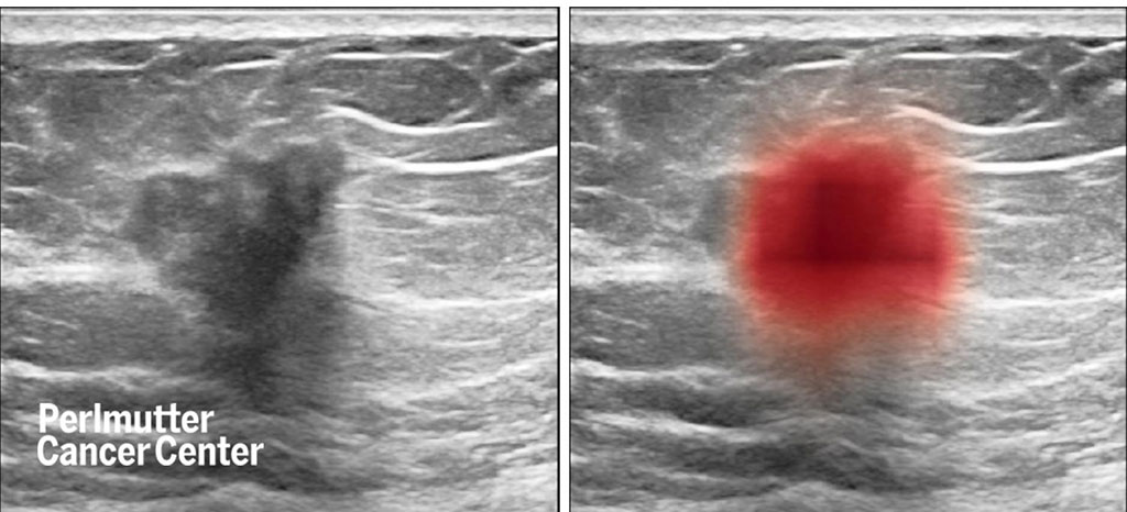 Image: Breast ultrasound images show cancer (at left, as dark spot in center and, at right, in red, as highlighted by a computer) (Photo courtesy of Nature Communications)