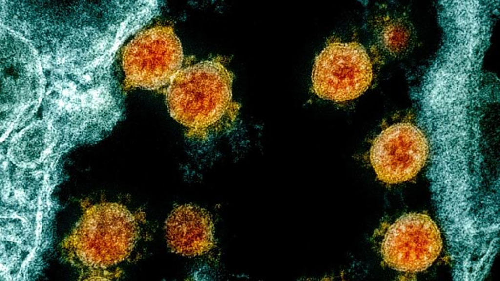 Image: This colorized transmission electron micrograph shows SARS-CoV-2 virus particles (orange), isolated from a patient (Photo courtesy of NIAID via NIH)