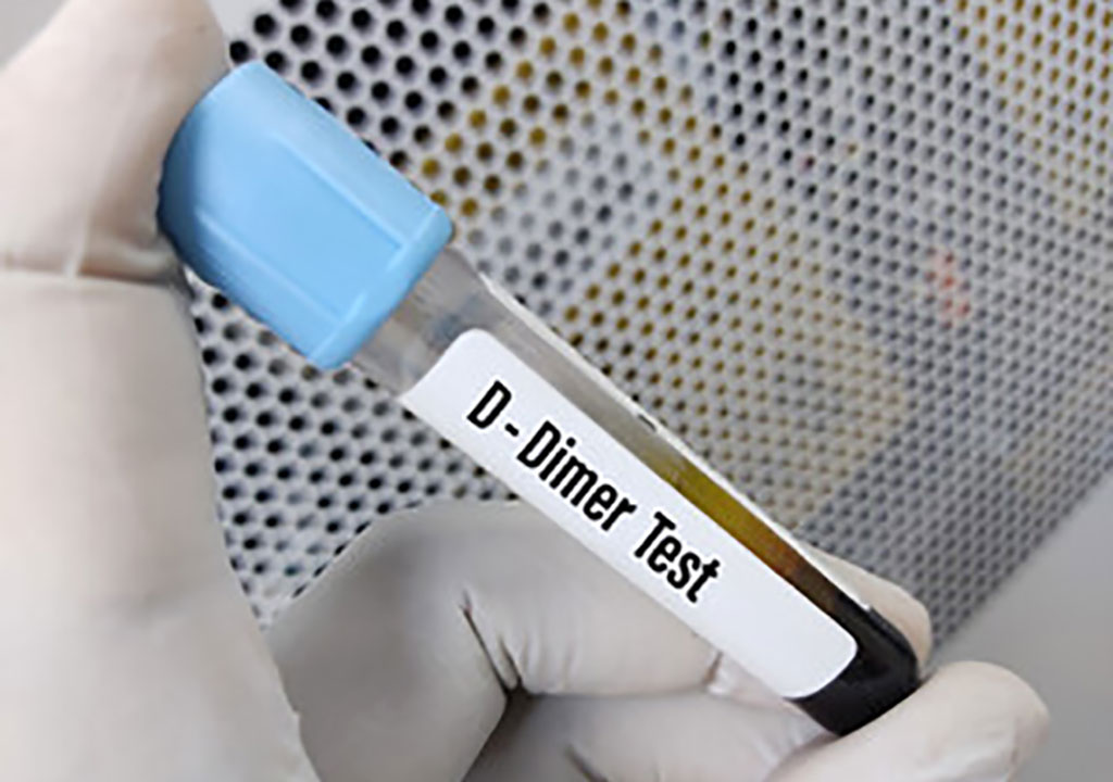 Image: D-Dimer Test (Photo courtesy of USF Health)