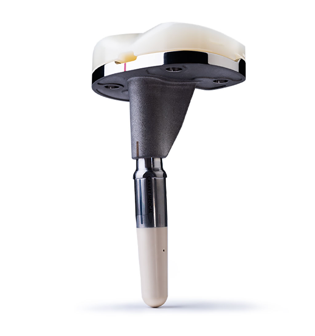 Image: The Persona IQ TKA implant with CTE attached (Photo courtesy of Zimmer Biomet)