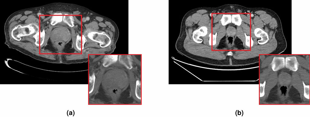 Image: CT slices of a patient with prostate cancer (a), and one without (b) (Photo courtesy of SVHM/ RMIT)