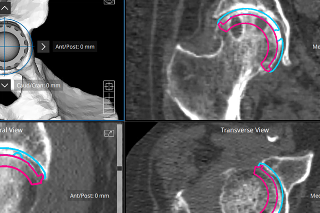 Image: The Naviplan application helps plan total hip replacements (Photo courtesy of Naviswiss)