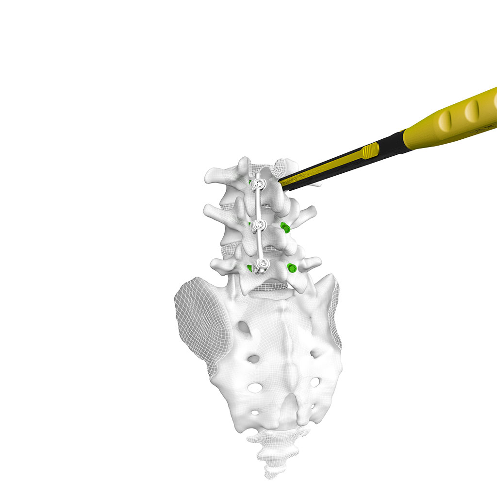 Image: The CentraFix Midline Fixation System offers strength without compromise (Photo courtesy of CoreLink)
