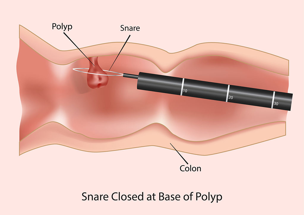 Image: Cold snares are safe for removing GI polyps, even large ones (Photo courtesy of Shutterstock)