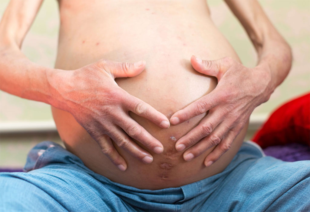 Image: An ascites patient with abdominal paracentesis scars (Photo courtesy of iStock)