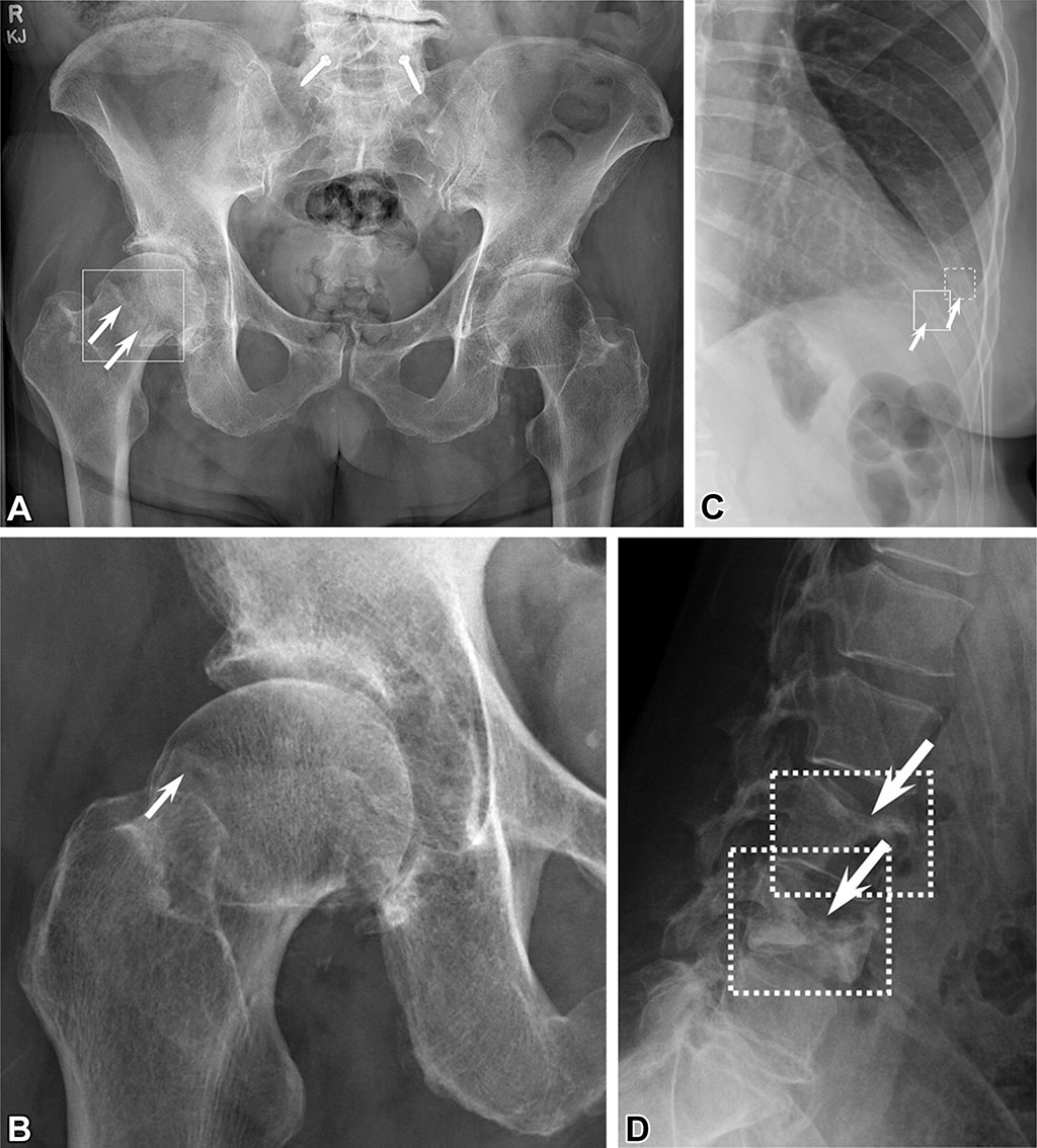 Image: Examples of fractures detected using the AI BoneView algorithm (Photo courtesy of BUSM)