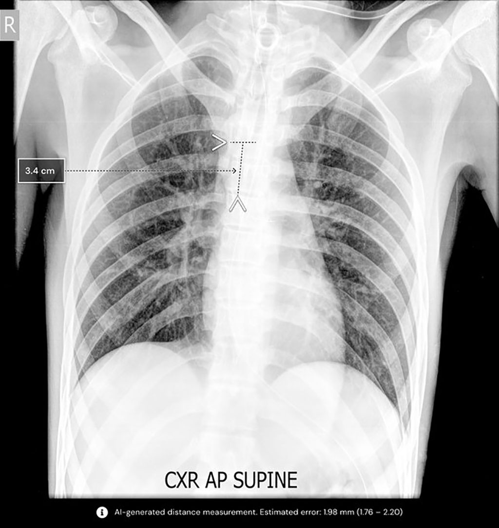 Image: AI Technology to assess breathing tube placements through chest X-rays receives FDA clearance (Photo courtesy of Qure.ai)