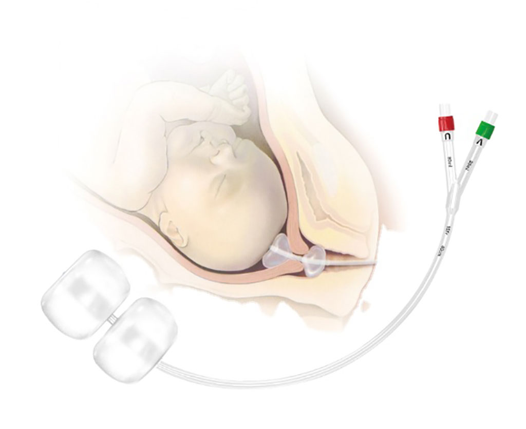 Image: Balloon catheters can hasten cervical ripening (Photo courtesy of Cook Medical)