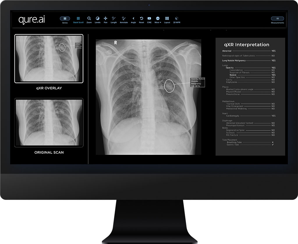 Image: AI software identifies correct placement of breathing tubes (Photo courtesy of Qure.ai)