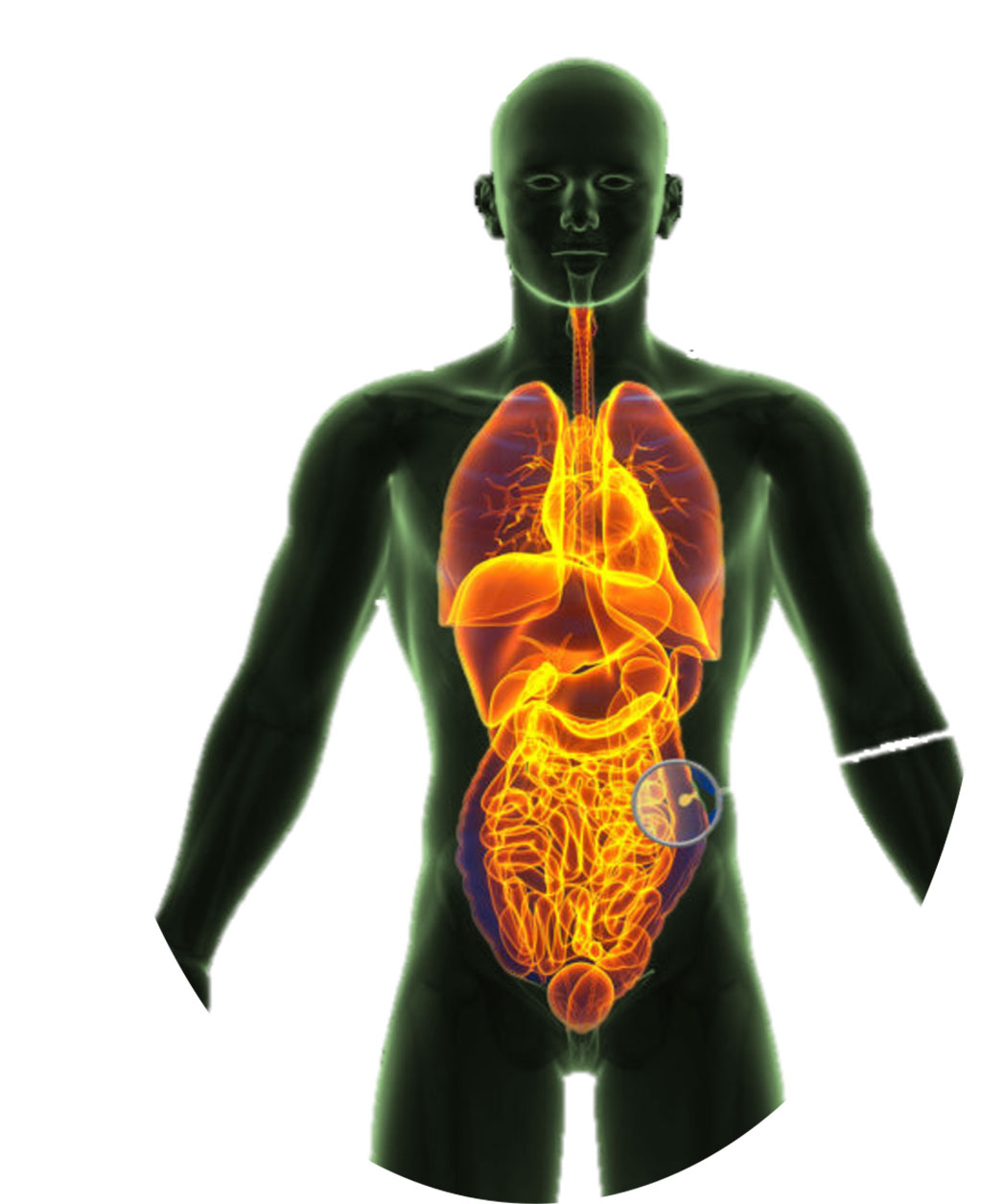 Image: BioDevek hydrogel for endoscopic application (Photo courtesy of BioDevek) Image: BioDevek hydrogel for endoscopic application (Photo courtesy of BioDevek)