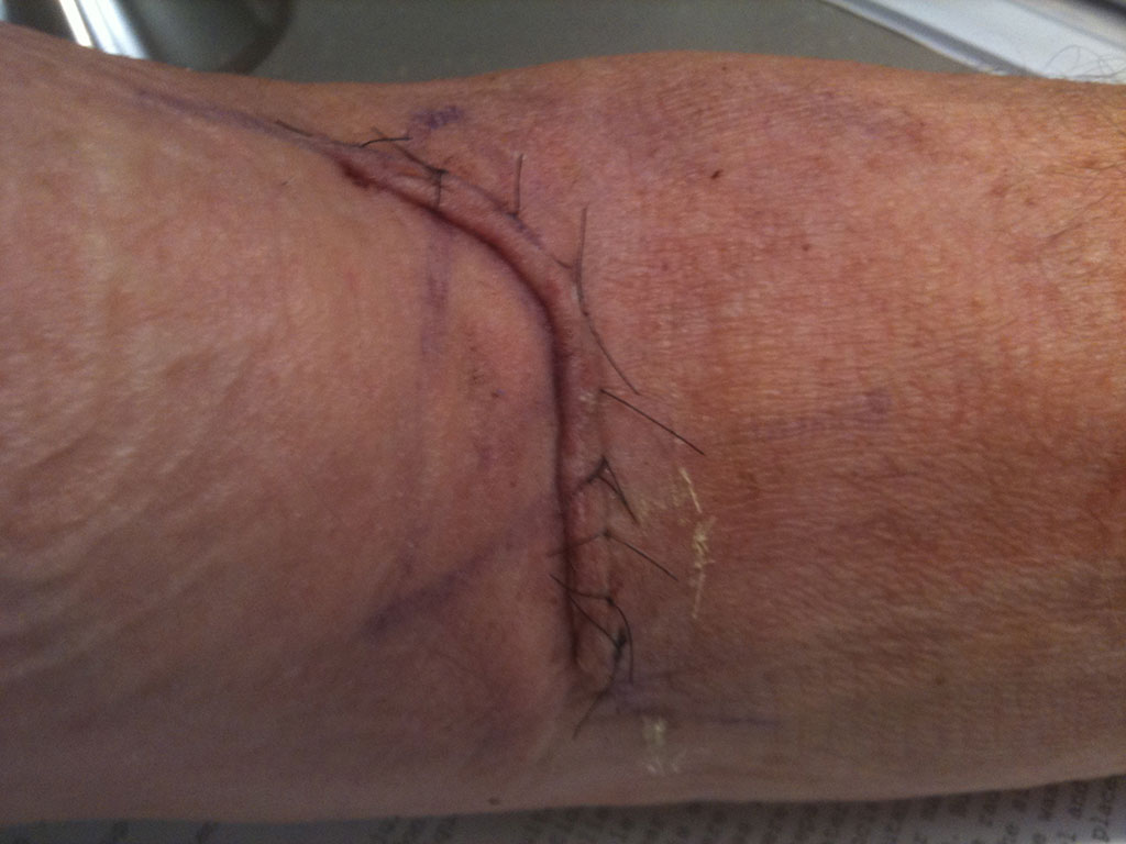 Image: Surgical incision (Photo courtesy of Oregon State University)