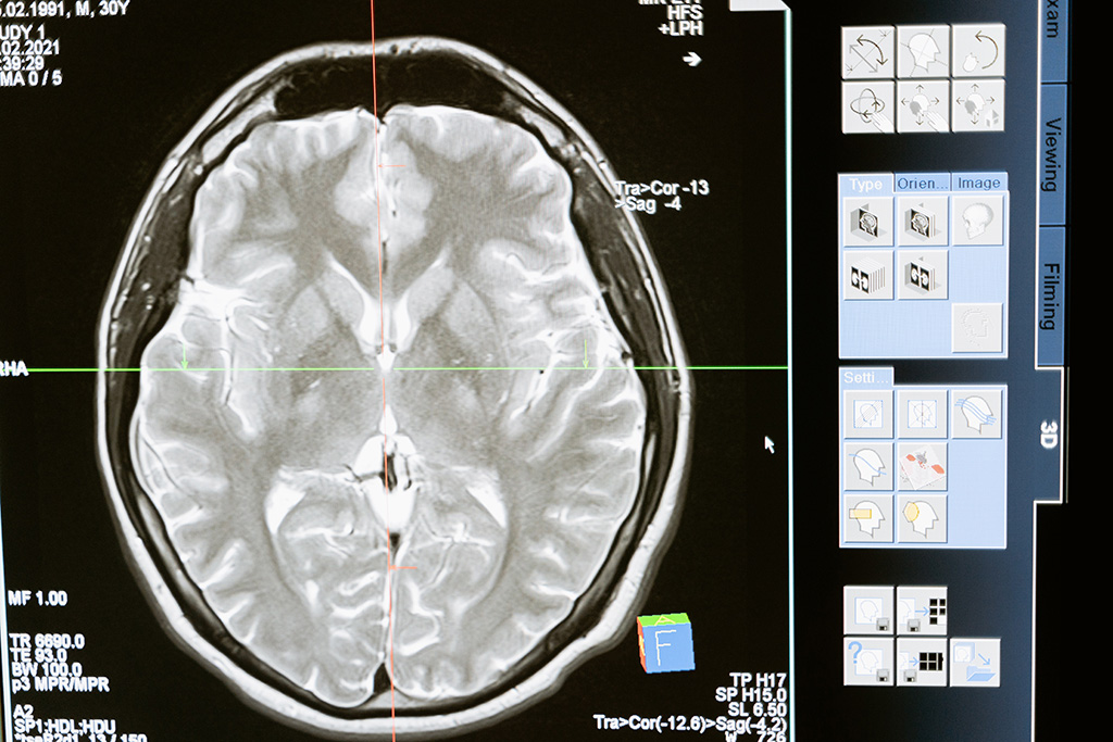 Image: Grey matter volume could inform treatment decisions for developing mental health disorders (Photo courtesy of Pexels)