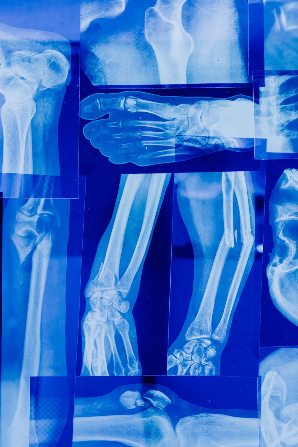 Image: Bioprinting for bone repair improves with genes (Photo courtesy of Pexels)