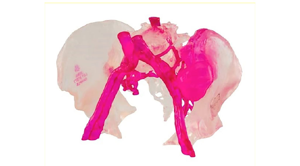 Image: My3D Personalized Pelvic Reconstruction system has received 510(k) clearance (Photo courtesy of Onkos Surgical)