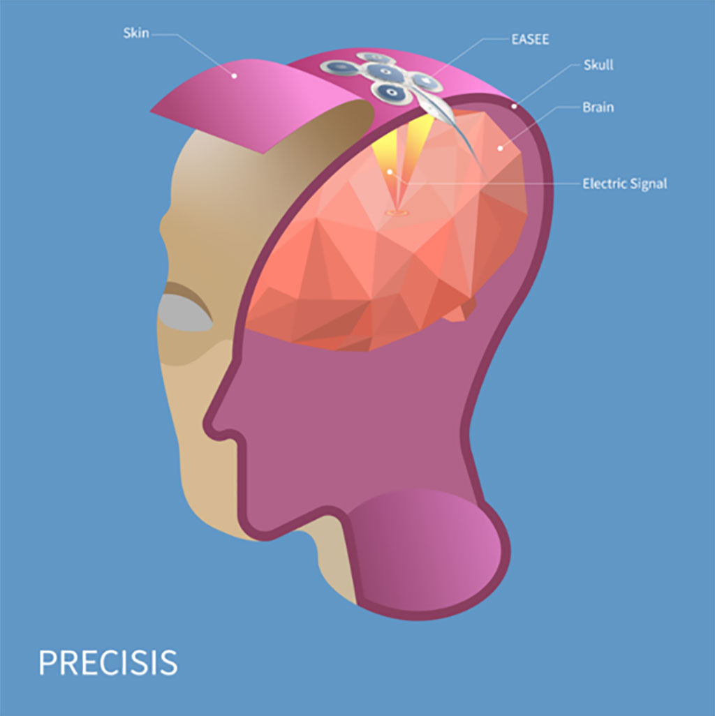 Image: The EASEE minimally invasive brain pacemaker has received CE certification (Photo courtesy of Precisis GmbH)