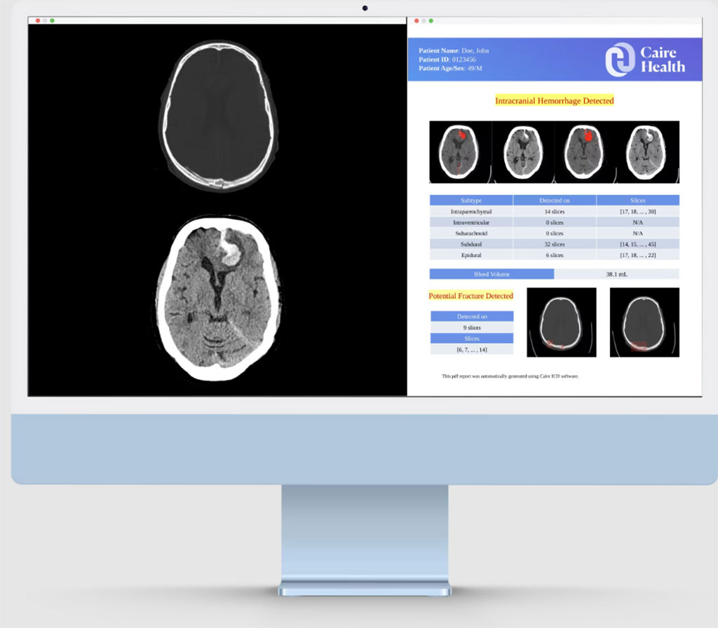 Image: Caire ICH immediately detects or rules out ICH (Photo courtesy of Caire Health)