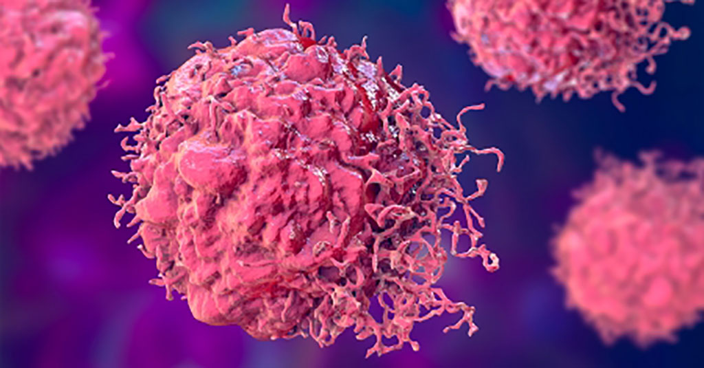 Image: Timely surveillance with chest imaging may benefit colorectal cancer patients (Photo courtesy of MD Anderson)
