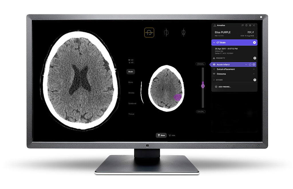 Image: The Annalise Enterprise CTB module assists radiologists with interpretation of radiological imaging studies (Photo courtesy of Annalise) Image: The Annalise Enterprise CTB module assists radiologists with interpretation of radiological imaging studies (Photo courtesy of Annalise)