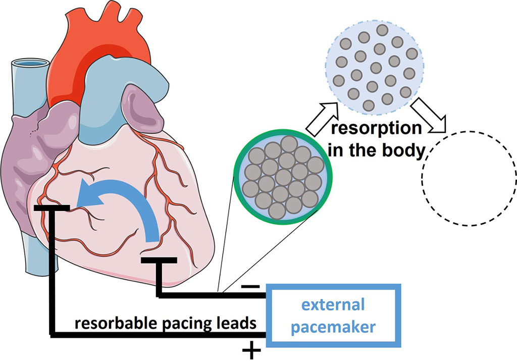 Image: After the postoperative monitoring period, the resorbable pacing leads slowly degrade in the body (Photo courtesy of Fraunhofer Society)