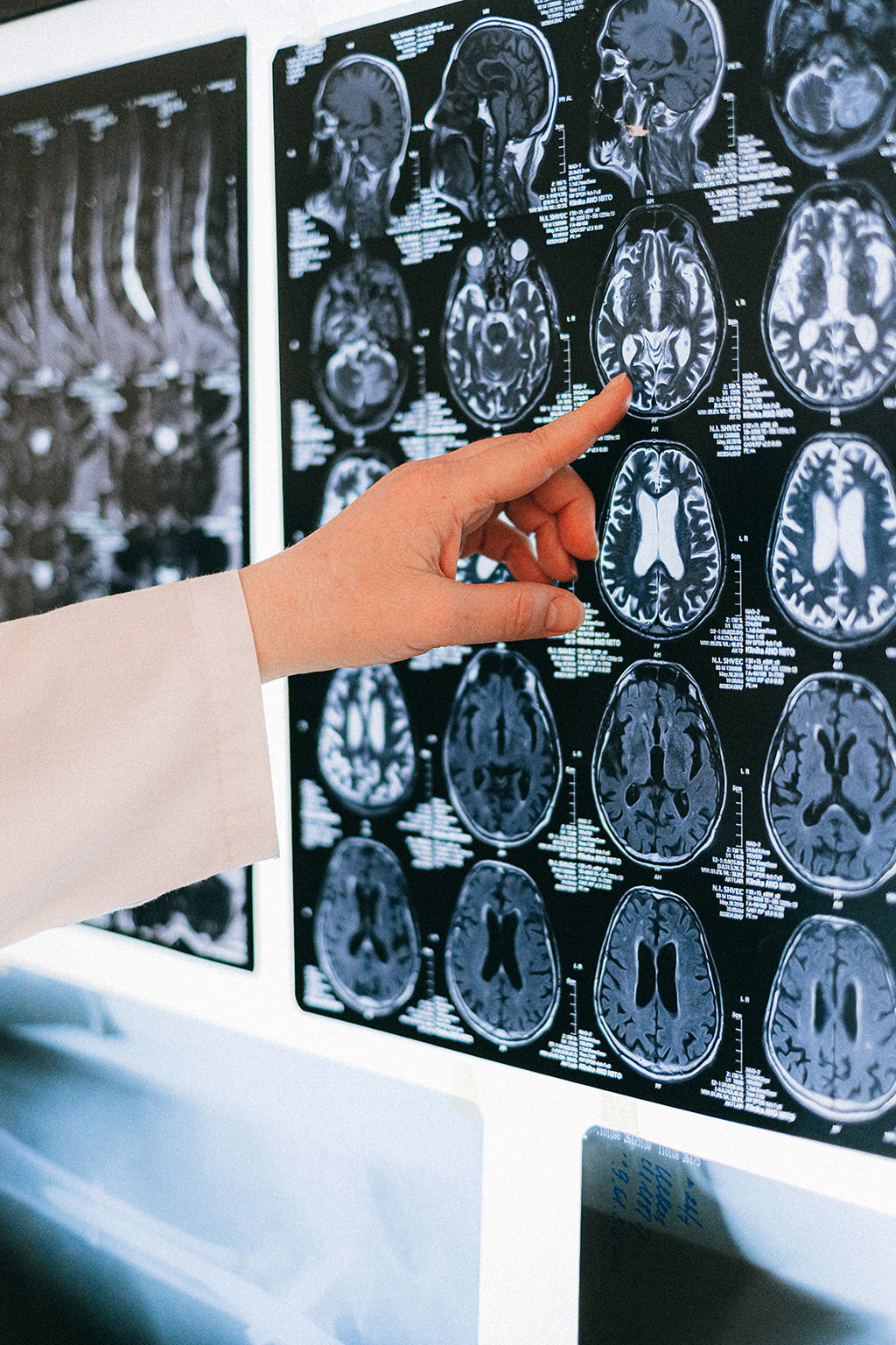 Image: Researchers are designing a customized device to improve brain aneurysm treatment (Photo courtesy of Pexels)