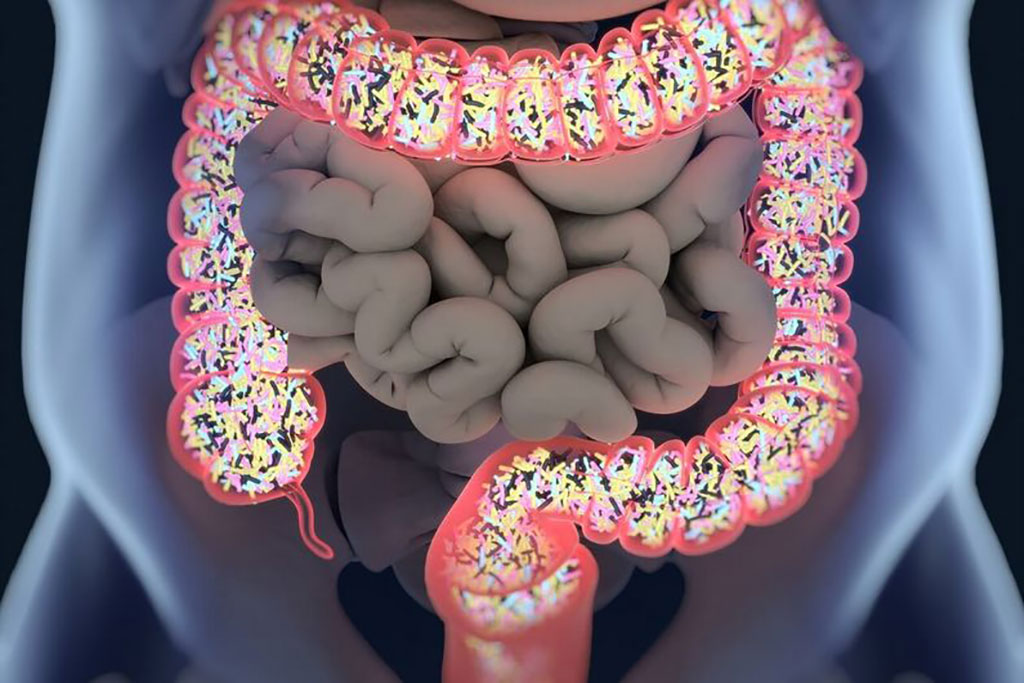 Image: Gut microbiota helps healing in colorectal cancer surgery (Photo courtesy of CRCHUM)
