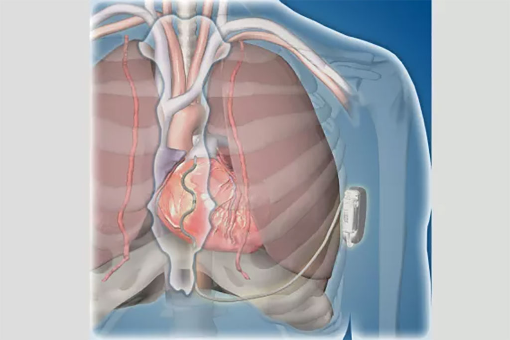 Image: EV-ICD defibrillation lead placed outside of heart and veins, preserving vasculature (Photo courtesy of Medtronic)