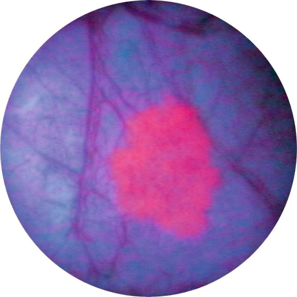 Image: Bladder seen through a cystoscope under blue light (Photo courtesy of Photocure)