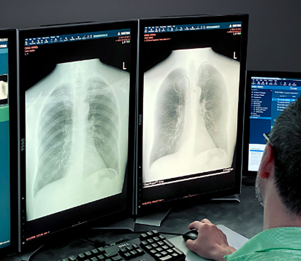 Image: The ClearRead Xray deep learning algorithm allows clinicians to see beyond bone structure barriers (Photo courtesy of Riverain) Image: The ClearRead Xray deep learning algorithm allows clinicians to see beyond bone structure barriers (Photo courtesy of Riverain)