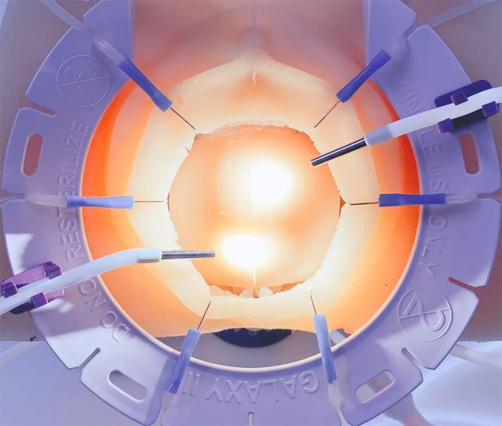 Image: The Galaxy II LUX Connect is the worlds’ first self-retaining ring retractor with light (Photo courtesy of JUNE)