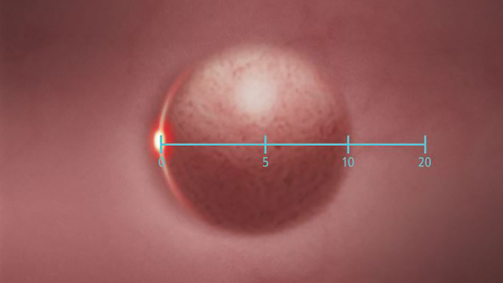 Image: SCALE EYE aids endoscopists in estimating the size of lesions in the colon (Photo courtesy of FUJIFILM)
