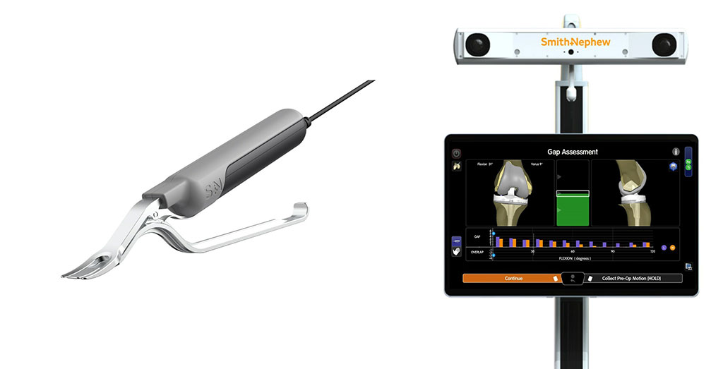 Image: CORI Digital Tensioner lets surgeons measure the ligament tension in a knee prior to cutting bone (Photo courtesy of Smith+Nephew)