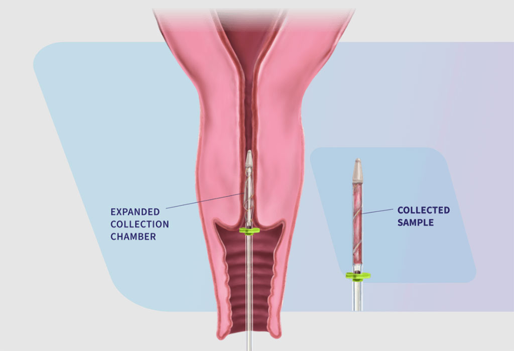 Image: FemCerv is the first and only approach for comprehensive tissue sampling for diagnosis of cervical cancer (Photo courtesy of Femasys)