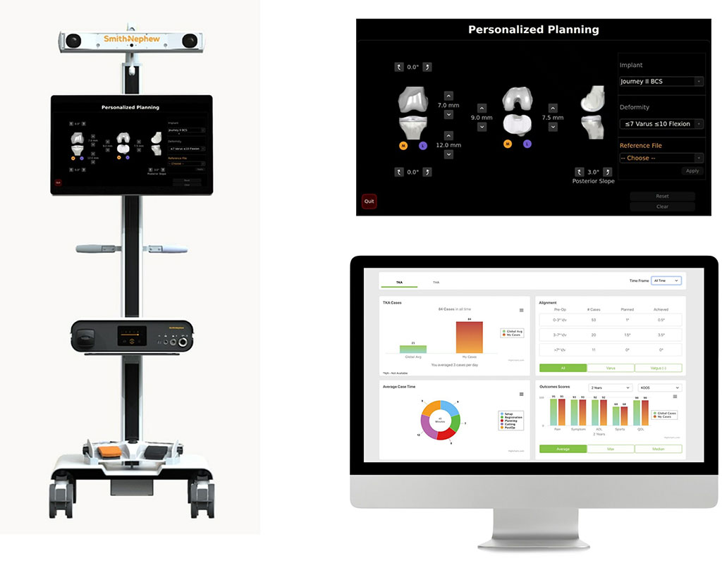 Image: CORI surgical system with personalized planning powered by AI and guided by RI.INSIGHTS data visualization platform (Photo courtesy of Smith+Nephew)
