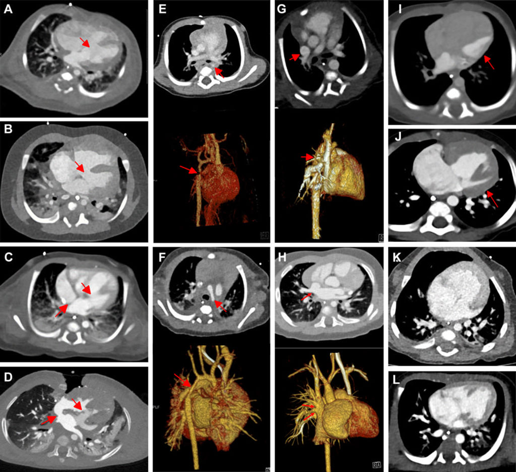 Image: DSCT and PCCT images for comparison of quality (Photo courtesy of RWTH) Image: DSCT and PCCT images for comparison of quality (Photo courtesy of RWTH)