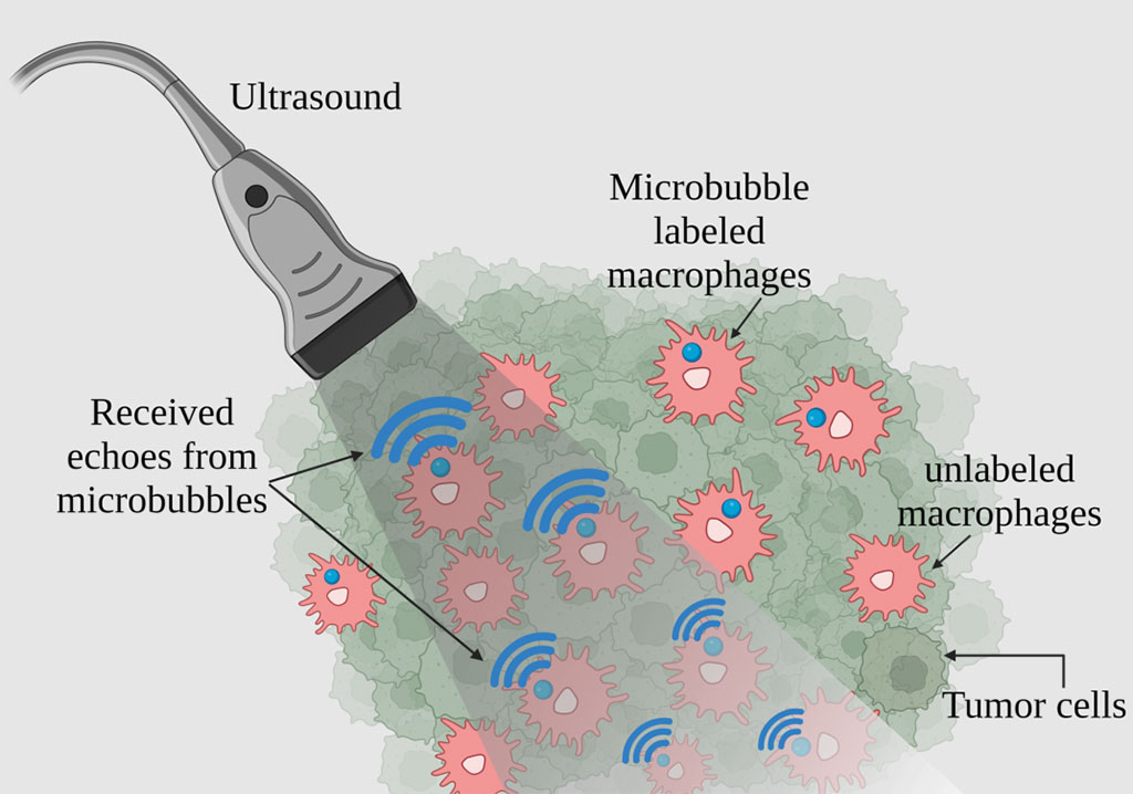 Image: Attaching microbubbles to macrophages can create high-resolution and sensitive tracking images useful for disease diagnosis (Photo courtesy of Georgia Institute of Technology) Image: Attaching microbubbles to macrophages can create high-resolution and sensitive tracking images useful for disease diagnosis (Photo courtesy of Georgia Institute of Technology)