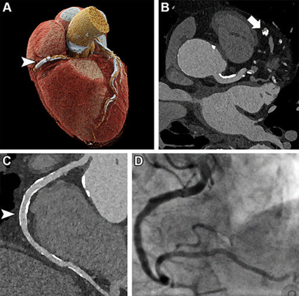 Image: Ultra high-resolution coronary CT angiography in an 85-year-old man before transcatheter aortic valve replacement (Photo courtesy of University of Freiburg)