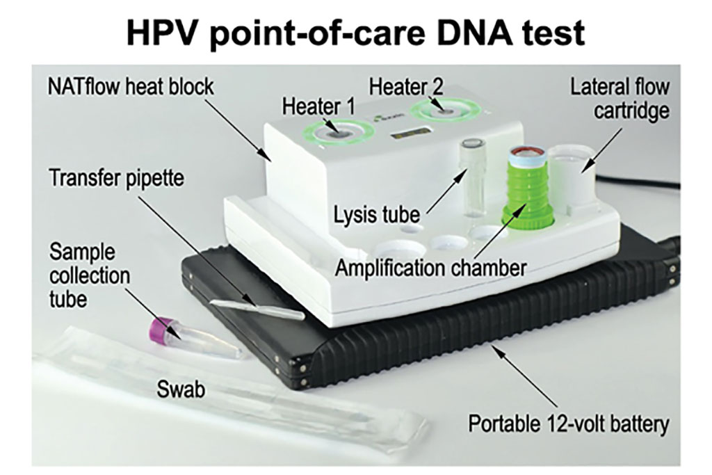 Image: The low-cost, POC DNA test for HPV infections delivers results in 45 minutes (Photo courtesy of Rice University)