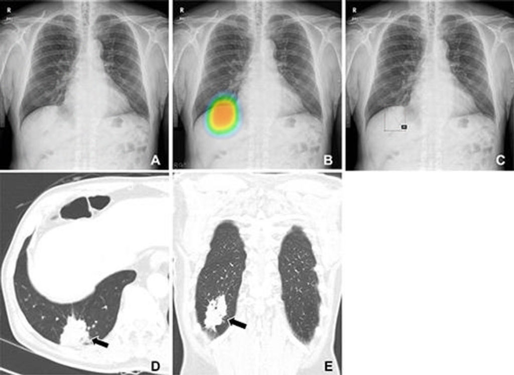 Image: A high accuracy AI algorithm improves lung cancer detection (Photo courtesy of Seoul National University) Image: A high accuracy AI algorithm improves lung cancer detection (Photo courtesy of Seoul National University)