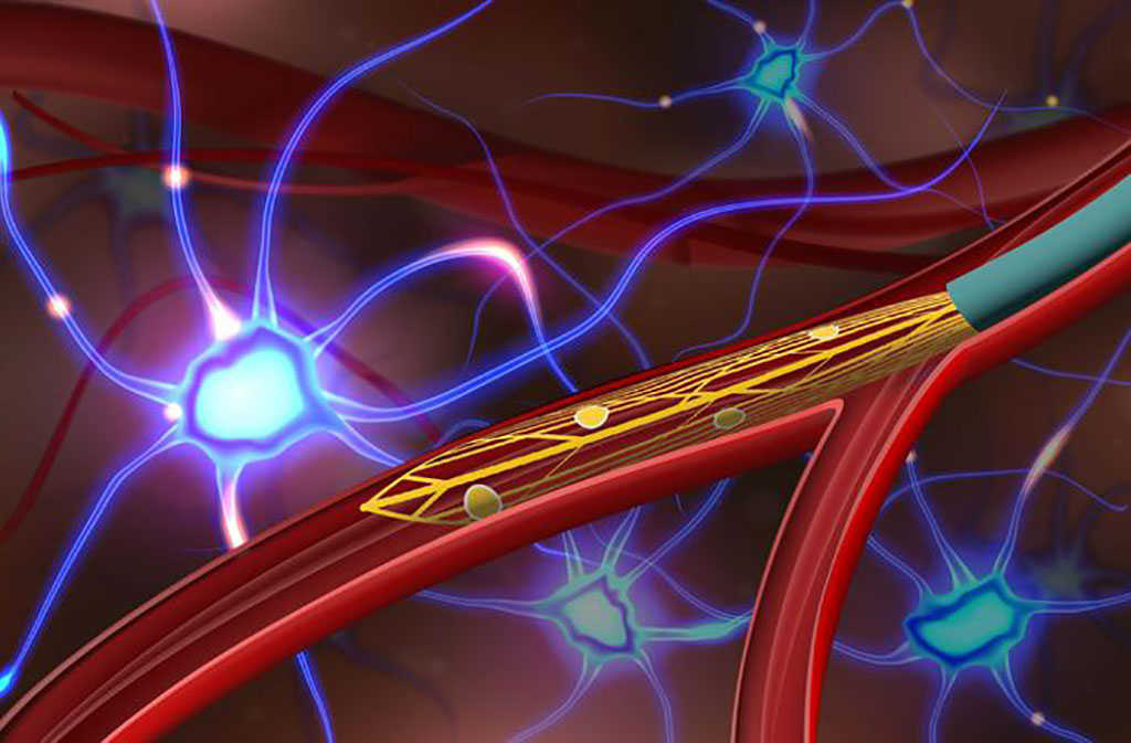 Image: MEV probe selectively implanted into curved branch for neural recording across blood vessel wall (Photo courtesy of Stanford University)