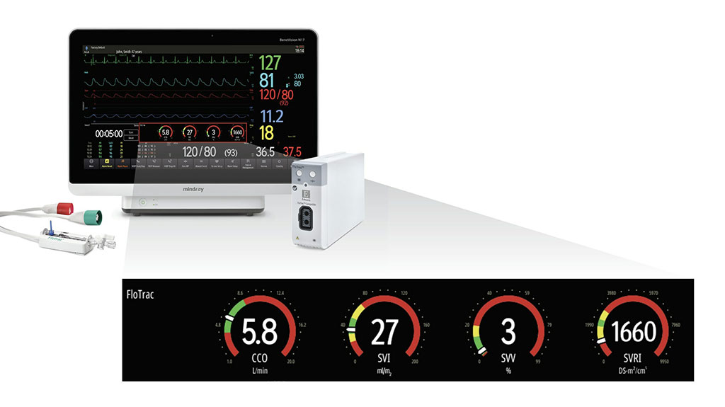 Image: The BeneVision N-Series is the first patient monitoring platform to integrate Edwards’ FloTrac sensor technology (Photo courtesy of Mindray)